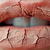 Parched_Lips